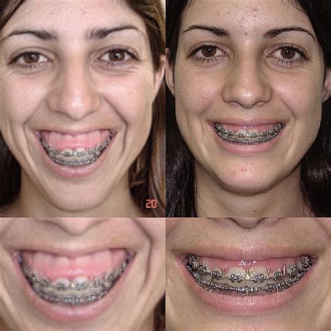 orthognathic surgery gummy smile.